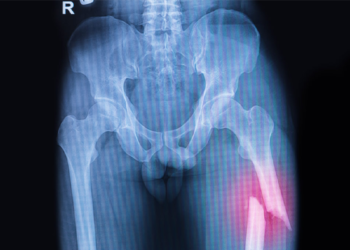 IIT Guwahati develops AI assisted model to predict healing of thigh bone fractures