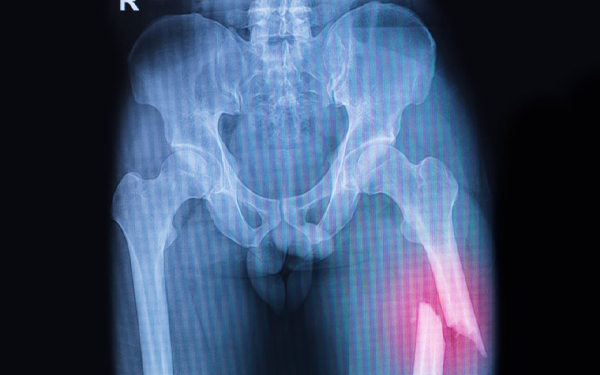 IIT Guwahati develops AI assisted model to predict healing of thigh bone fractures