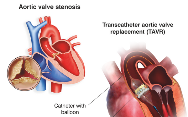 aortic stenosis