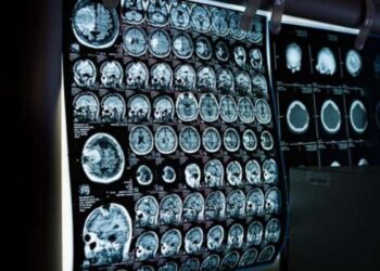 Hinduja unicorn MindMaze launches smart peripheral for patients with hand motor impairment