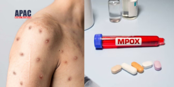 Kerala to Issue New Mpox Guidelines Post New Strain